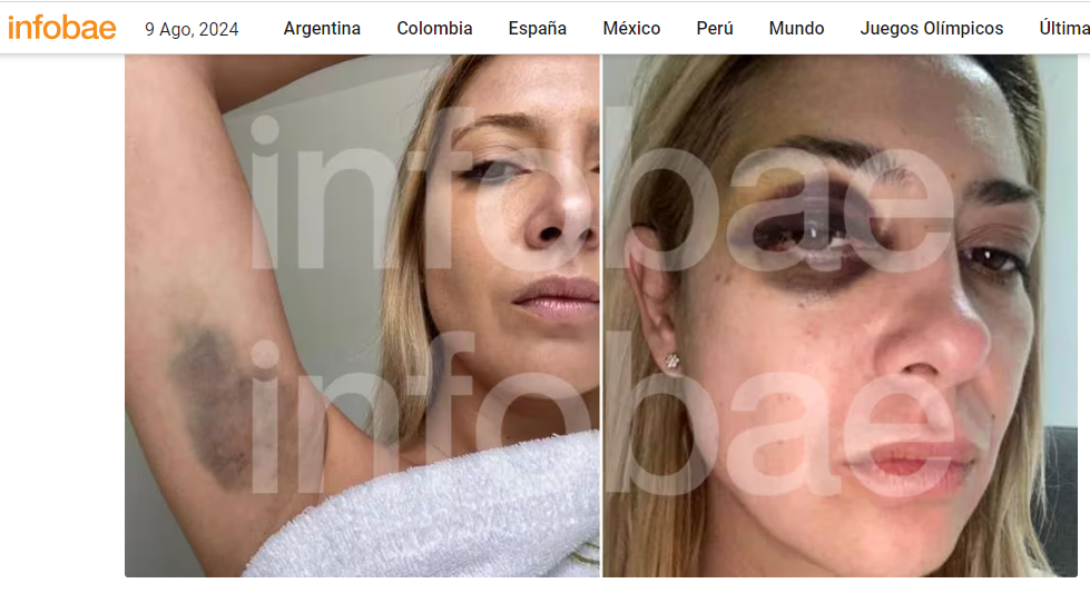 Site exibe fotos que esposa usou para acusar ex-presidente argentino de agressão